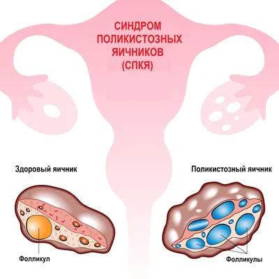 Мультифолликулярные яичники, поликистозные яичники и кисты яичников звучат,  кажется, похоже. Неудивительно, что их часто пустуют. В чем же… | Instagram