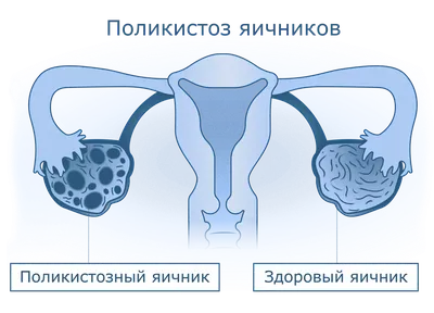 Где находятся придатки у женщин (фото), аднексит – что это такое, чем лечить