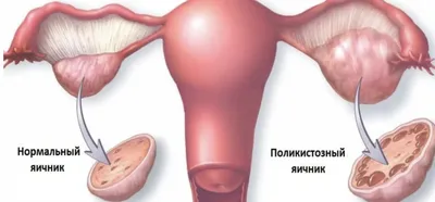 Образования яичников из остаточной надпочечниковой ткани у женщины с  сольтеряющей формой врожденной дисфункции коры надпочечников | Молашенко |  Эндокринная хирургия