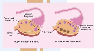 Поликистоз яичников - причины появления, симптомы заболевания, диагностика  и способы лечения