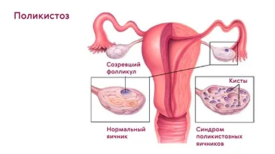 Рак яичников лечение в Индии по самой низкой цене