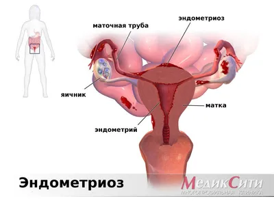 Дисфункция яичников – симптомы, причины, диагностика и лечение в клинике  «Будь Здоров»