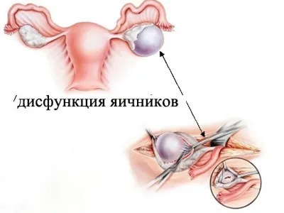 Педиатр Юлия Неизвесная - Поликистоз яичника – это гормональное  расстройство, которое возникает в результате неправильной работы органов и  желез (в частности – поджелудочной железы), выделяющих такие гормоны как  прогестерон, эстроген и андроген.