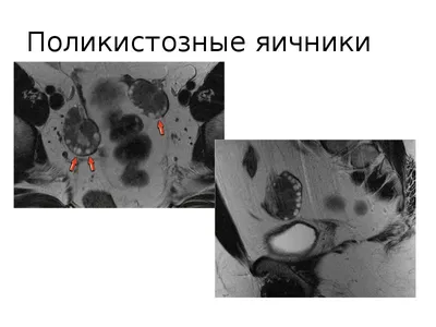 Что означает диагноз \"мультифолликулярные яичники\"? | Клиника Адам и Ева |  Дзен