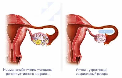 Киста яичника: симптомы у женщин и девушек, признаки кисты, причины  появления, лечение