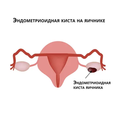 Первичная недостаточность яичников (ПНЯ). Вопросы - Забота о здоровье  женщины