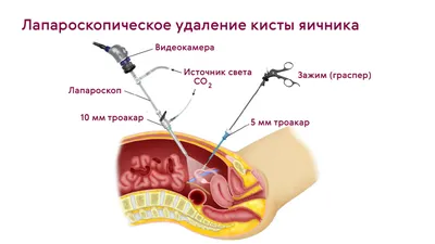 Образования яичников из остаточной надпочечниковой ткани у женщины с  сольтеряющей формой врожденной дисфункции коры надпочечников | Молашенко |  Эндокринная хирургия