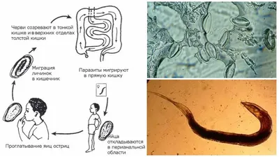 Медичний Центр Здоров'я • Харків - Соскоб на энтеробиоз. Энтеробиоз –  гельминтоз из группы нематодозов, вызываемый червями из рода остриц. На  10-е годы XXI века – самый распространённый гельминтоз человека.  Возбудитель энтеробиоза –