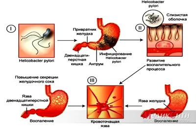 СИМПТОМЫ ЯЗВЫ ЖЕЛУДКА - Как отличить язву от другого заболеваяKupffer
