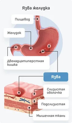 📝 Назван единственный симптом, который может говорить о язве желудка 👈 |  Энциклопедия Здоровья | Дзен