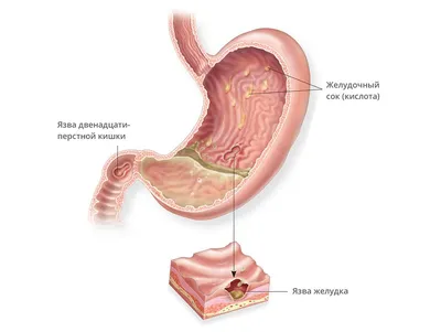 Язва желудка и двенадцатиперстной кишки. Лечение.