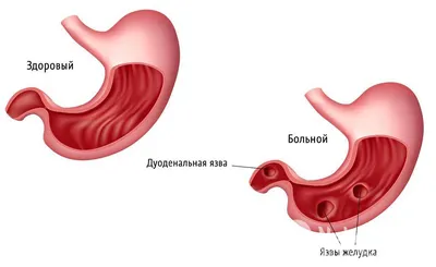 Язвенная болезнь (ЯБ) желудка лечение в Самаре. Цены