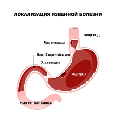 Язва желудка | Пробиотики Нормофлорины – лечение дисбактериоза