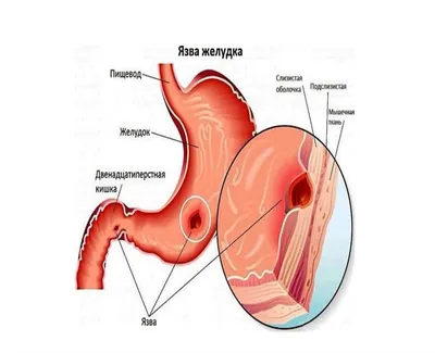 Язва желудка - признаки, причины, симптомы, лечение и профилактика -  iDoctor.kz