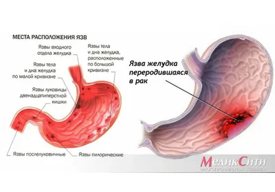 Язва желудка и двенадцатиперстной кишки. Лечение.