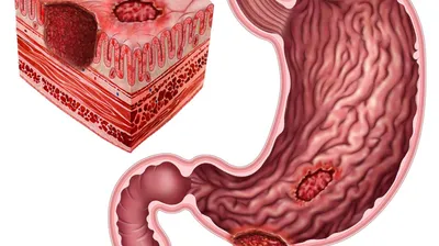 Лечение язвы желудка в Екатеринбурге - Новая больница