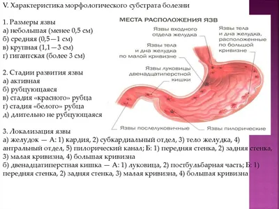 Диета при язве желудка: что нельзя и можно есть, меню на неделю