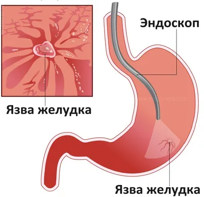 Язва желудка фото