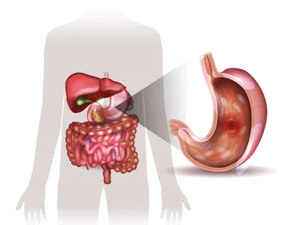 Язва желудка и двенадцатиперстной кишки | Конспекты лекций Хирургия |  Docsity