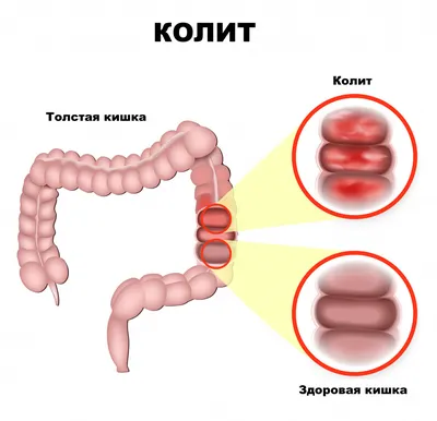 Язвенный колит - причины появления, симптомы заболевания, диагностика и  способы лечения