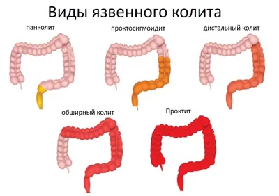 Лечение язвенного колита в Германии — Симптомы, диагностика и методы  лечения язвенного колита кишечника в клинике Nordwest