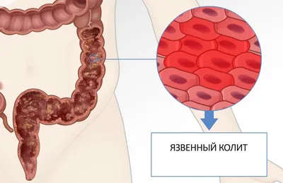 Колит — симптомы, лечение, диагностика и виды колита кишечника — Клиника  «Доктор рядом»