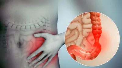 Новый метод лечения синдрома раздраженного кишечника и НЯК
