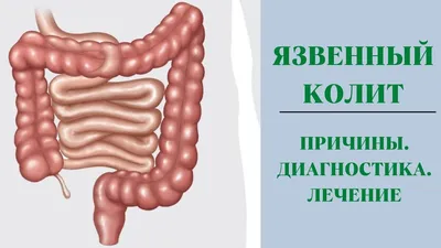 Язвенный колит. Причины. Диагностика. Лечение. | Доктор Силантьева | Дзен