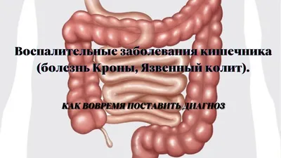 Статья «Неспецифический язвенный колит»