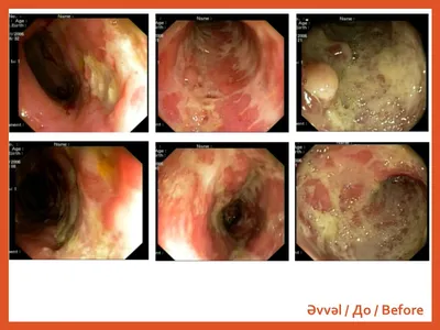 Язвенный колит фото