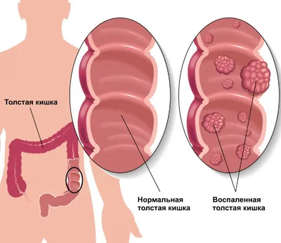 Лечение неспецифического язвенного колита в Екатеринбурге - Новая больница