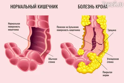 Язвенный колит | Справочник КЛРЦ