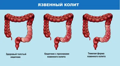 Колит - причины появления, симптомы заболевания, диагностика и способы  лечения