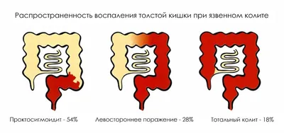 Лечение неспецифического язвенного колита в Екатеринбурге - Новая больница