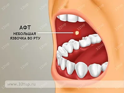 Стоматит - причины, симптомы, лечение | Профилактика у взрослых