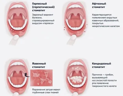 Герпетический стоматит - причины, симптомы, признаки, диагностика, лечение,  профилактика, рекомендации