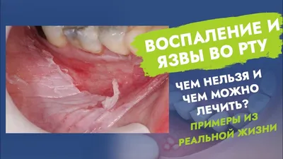 Рак языка: симптомы, причины, виды, стадии, диагностика и лечение онкологии  языка