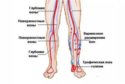 Язвы на ногах фото | До и после лечения Киев Запорожье