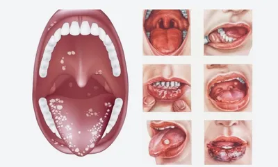 Герпес На Губе Языке В Горле 9 Фото Виды ЛюмиДент