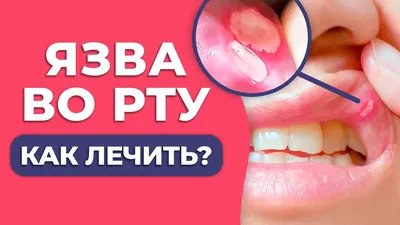 Стоматит — Википедия