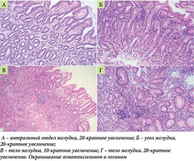 Гастрит желудка острый и хронический: симптомы, признаки, диагностика и  лечение