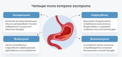 Курсовая ЛФК при гастритах | Дипломная Физическая медицина и реабилитация |  Docsity