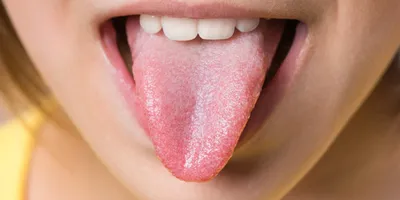 Налет на языке у взрослых — причины, цвета, признаки заболеваний в статье  на Startsmile.ru