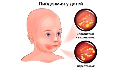 Импетиго лечение консультация в Санкт-Петербурге