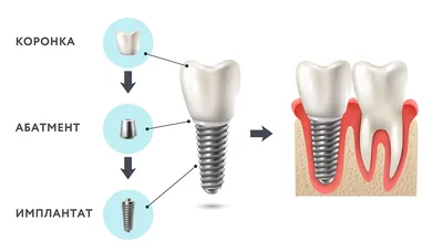 Имплантация одного зуба: цена за 1 имплант с установкой в Москве в клинике  OneDent