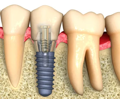 Выпал имплант зуба - причины, признаки, что делать