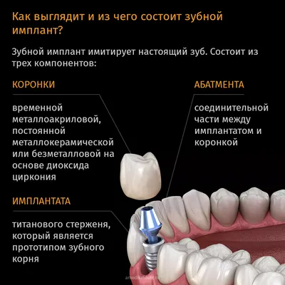 Одномоментная имплантация зубов после удаления: Цена в Киеве