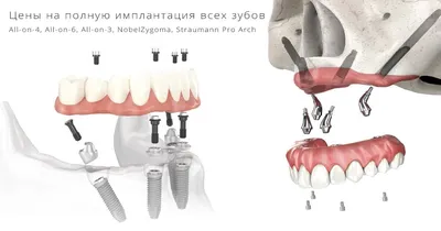 Имплантация зубов цены в Ногинске, стоимость установки зубного имплантата