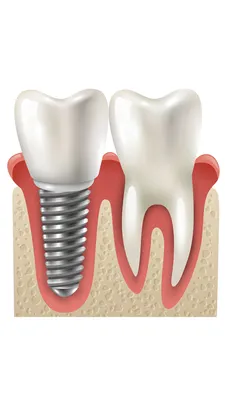 Имплантация при полном отсутствии зубов | Цены
