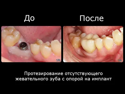 Опасно ли ставить зубные импланты?